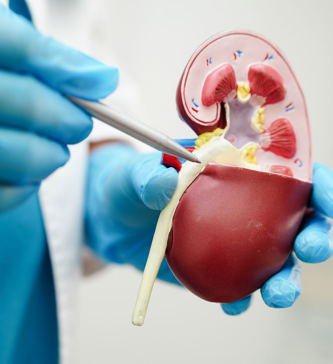 Top Specialists for Kidney Stone Surgery in Hyderabad You Can Trust